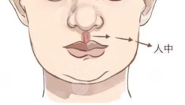 人中窝加深手术