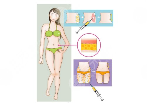 大腿抽脂18天完全消肿了吗