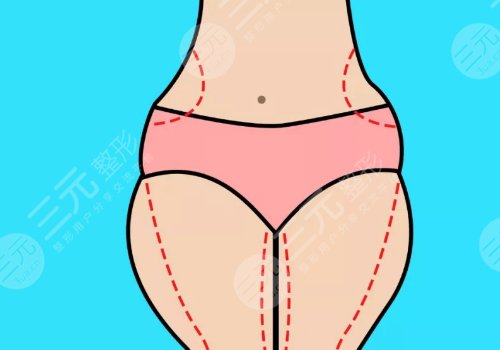 大腿抽脂18天完全消肿了吗