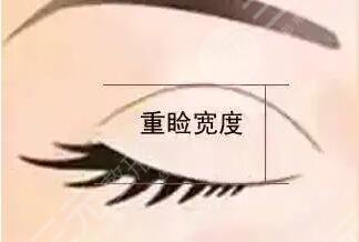 双眼皮