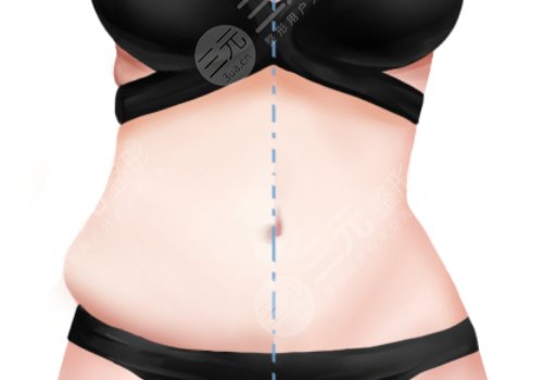 腰部环形吸脂手术大概多少钱