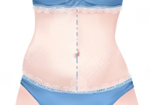 腰部环形吸脂手术大概多少钱