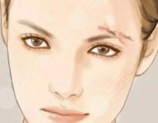 脸上有疤痕如何消除?祛疤去哪里做比较好 脸上有疤痕如何消除?祛疤去哪里做比较好