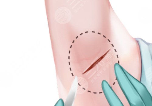 弋矶山医院整形美容科和皮肤科做腋下微创手术—样吗