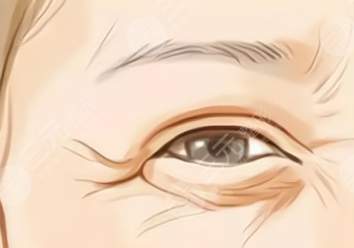 眼下干纹做什么医美