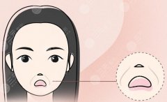 法令纹打什么针好?面部凹陷除皱,别乱来! 法令纹打什么针好?面部凹陷除皱,别乱来!