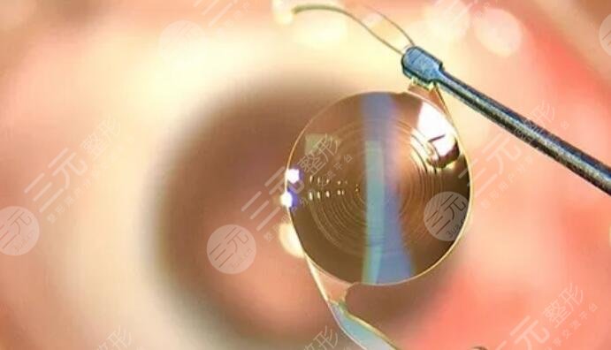 白内障晶体植入