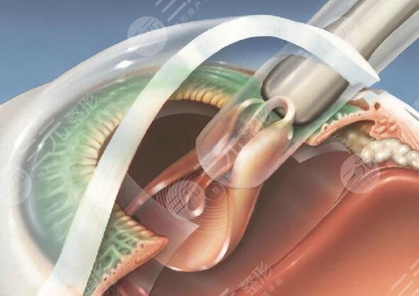 白内障晶体植入