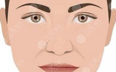 3d打印鼻基底是什么?面部凹陷填充小课堂,带你了解! 3d打印鼻基底是什么?面部凹陷填充小课堂,带你了解!