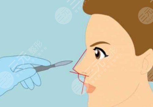 隆鼻膨体价格一般要多少