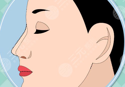 超肋隆鼻多少钱