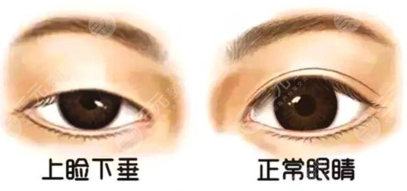 上睑下垂术