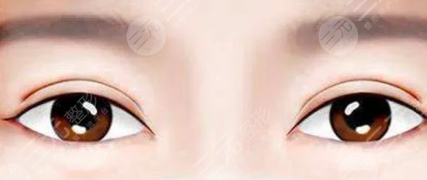 双眼皮