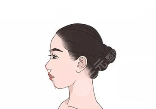 下颌骨歪斜怎么矫正