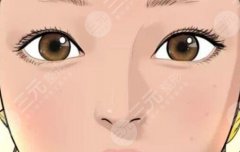 双眼皮割深了补救方法是什么？割双眼皮手术多久才能恢复