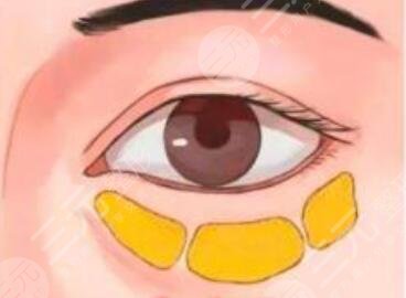 泪沟填充