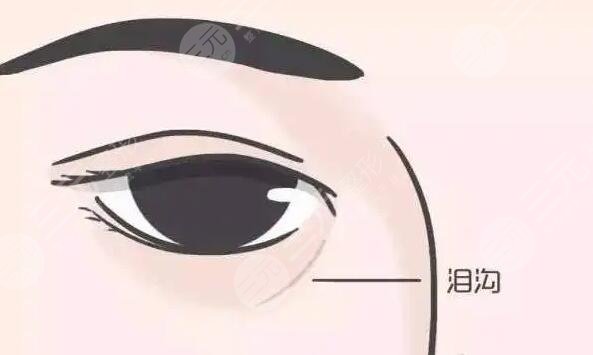 除泪沟