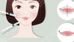 玻尿酸丰唇可以维持多久?美唇指南,术前必看! 玻尿酸丰唇可以维持多久?美唇指南,术前必看!