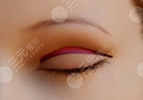 割双眼皮第七天恢复图