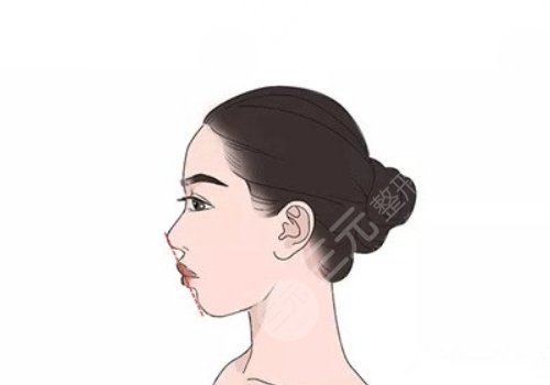 下颌角手术后遗症是什么