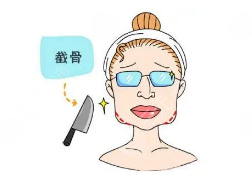下颌角整形费用