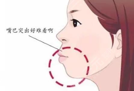 凸嘴