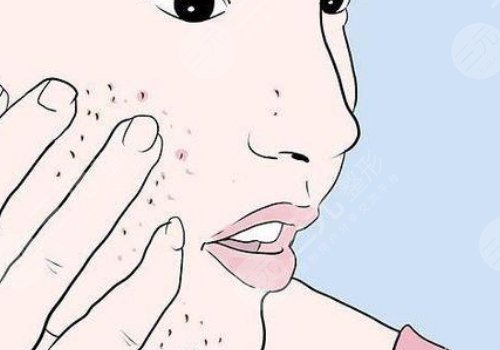 四会紫盈美容院去痘坑怎么样