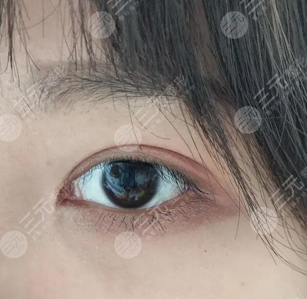 全切双眼皮手术
