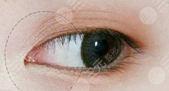 李桂珍医生双眼皮手术案例