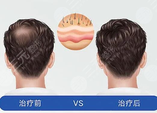 江苏省中医院植发多少钱?