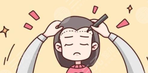 发际线种植