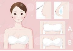 隆胸假体的价格是多少?费用参考再2万元左右起!附假体品牌介绍 隆胸假体的价格是多少?费用参考再2万元左右起!附假体品牌介绍