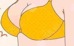 缩胸手术风险大吗？在线查看风险有哪些