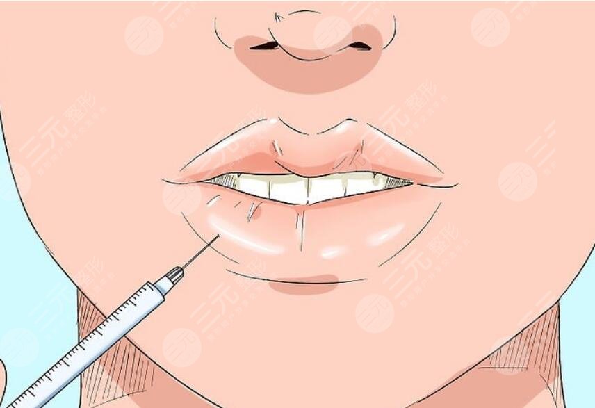 丰唇手术