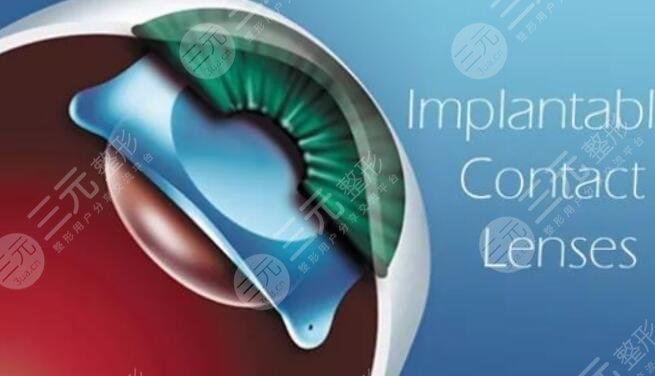 人工晶体植入术