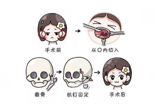 武汉五洲整形外科医院做下颌角手术费用