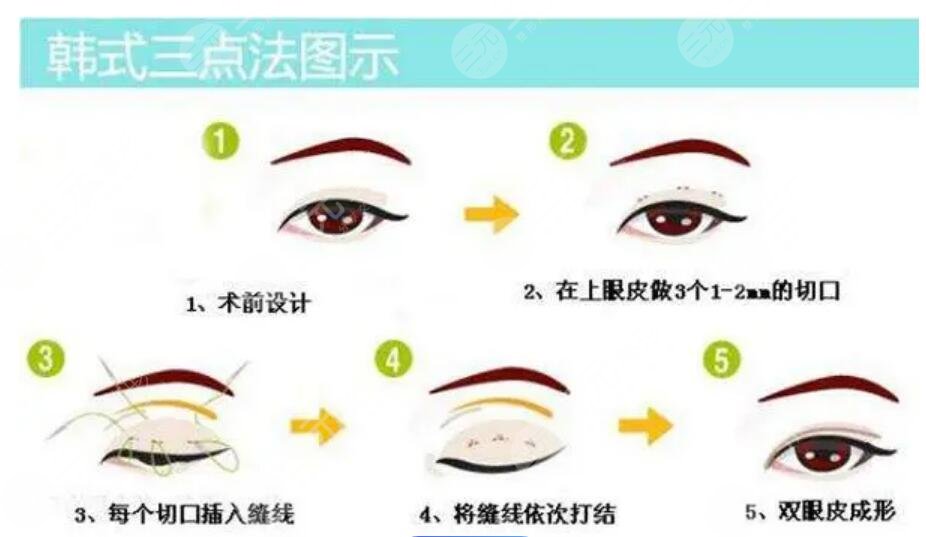 双眼皮手术