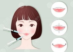 丰唇玻尿酸大中小分用哪个?有什么注意事项吗?科普知识介绍 丰唇玻尿酸大中小分用哪个?有什么注意事项吗?科普知识介绍