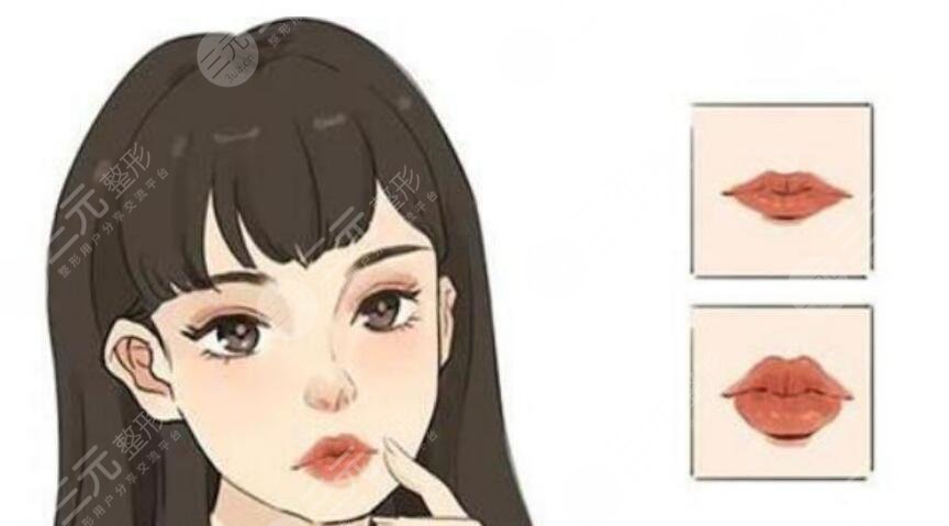 丰唇
