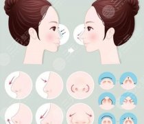鼻基底凹陷手术多少钱?贵不贵?附术后护理方法盘点! 鼻基底凹陷手术多少钱?贵不贵?附术后护理方法盘点!