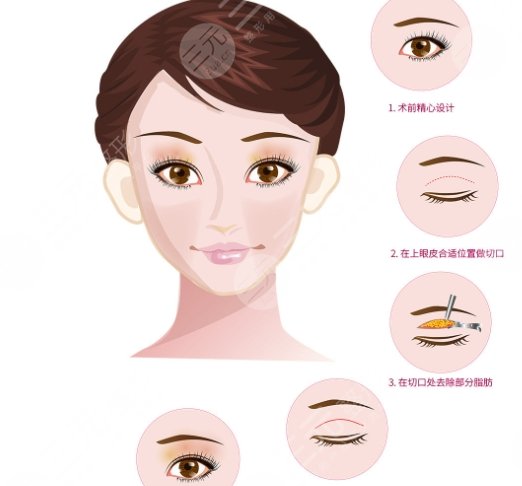 双眼皮手术