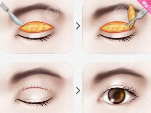双眼皮手术