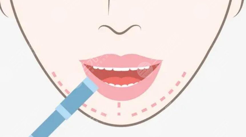 纹唇手术