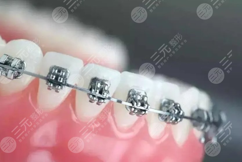 牙齿矫正
