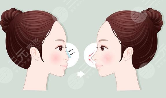 鼻畸形矫正项目