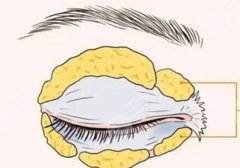 埋线双眼皮多久恢复自然呢?优缺点分析!来看详细介绍 埋线双眼皮多久恢复自然呢?优缺点分析!来看详细介绍