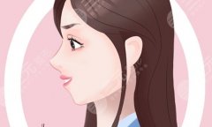 下巴颏成型多久恢复？术后会出现反弹现象吗？