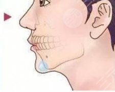 medpor垫下巴多久拆线？垫下巴可以改变凸嘴的现象吗？