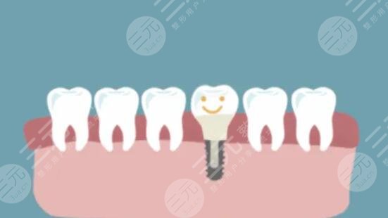 牙齿种植