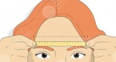 垫眉弓后遗症是什么？材料如何选择？术前准备介绍